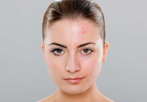 How to Exfoliate Acne-Prone Skin: A Dermatologist's Guide – Misumi
