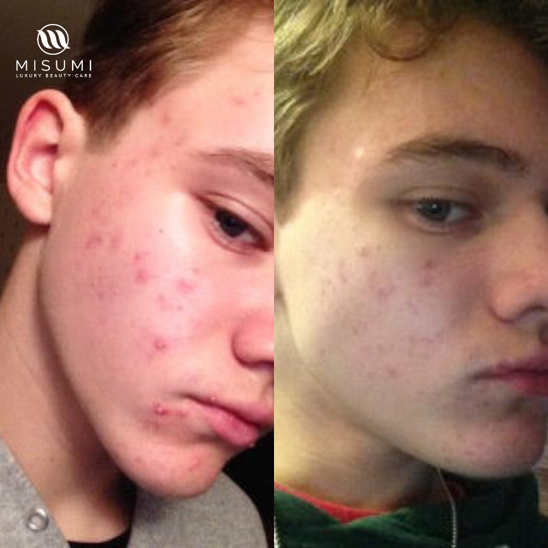 Acne Control Trio Kit