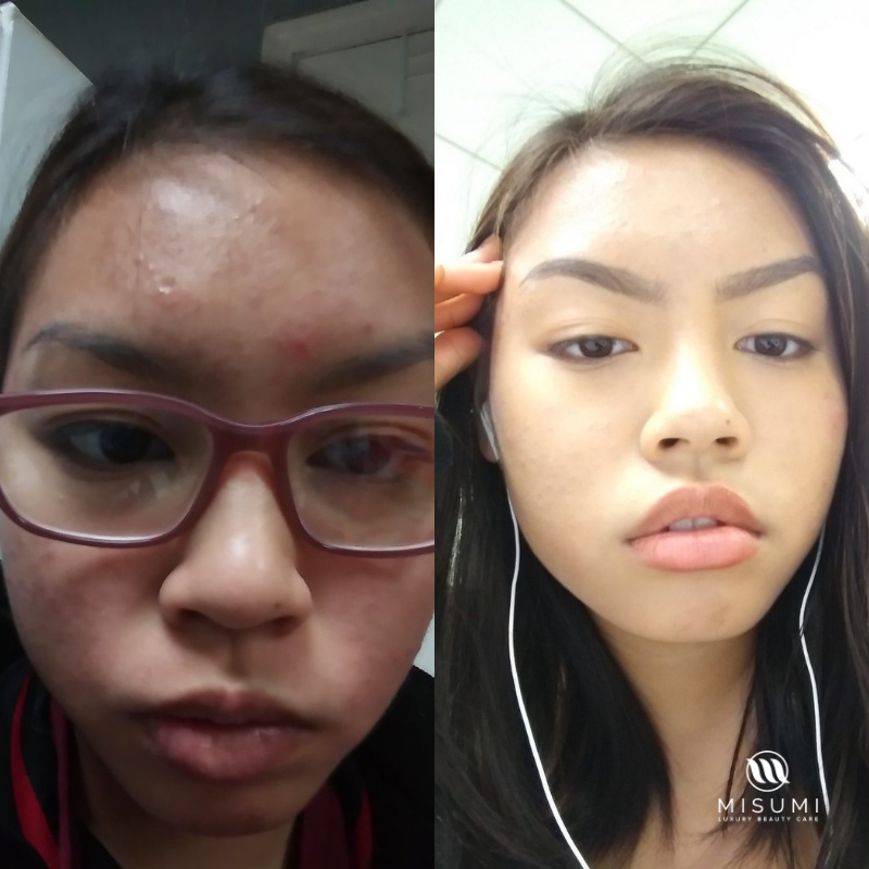 Acne Control Trio Kit
