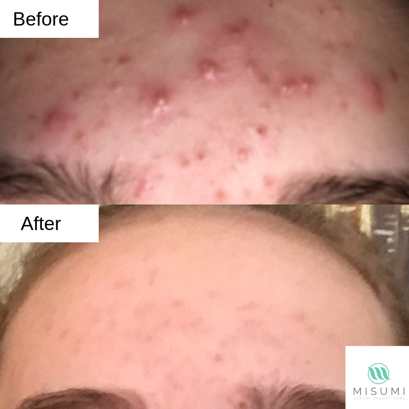 Acne Control Trio Kit