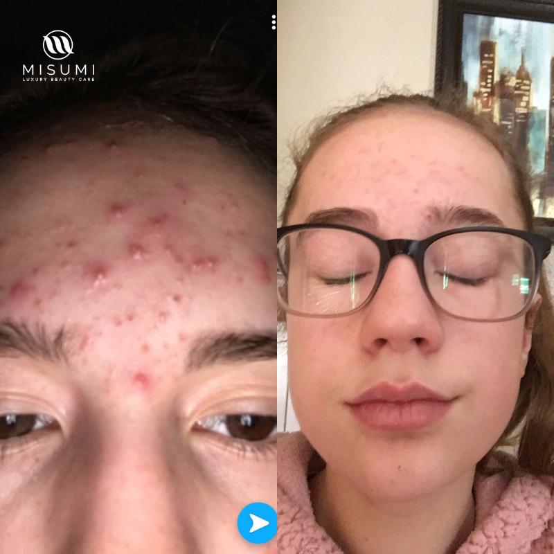 Acne Control Trio Kit
