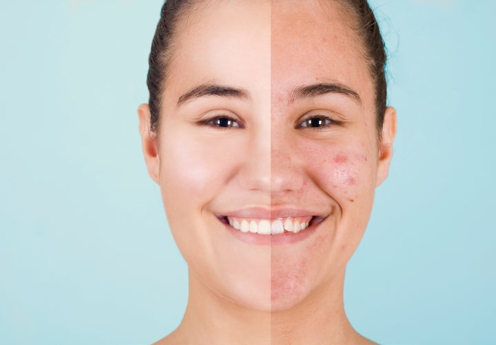 Does Touching Your Face Cause Acne? Separating Myth from Fact