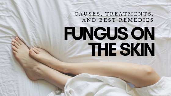 What Causes Fungus on Skin? Effective Treatments and Solutions