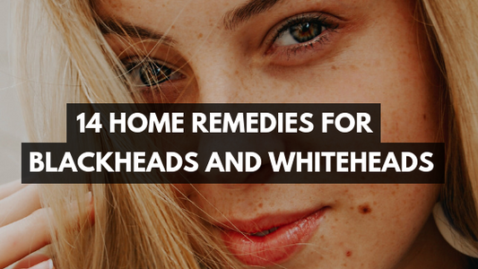 14 Home Remedies for Blackheads and Whiteheads