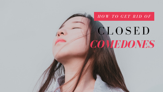 How to Get Rid of Closed Comedones and Achieve Smooth, Glowing Skin