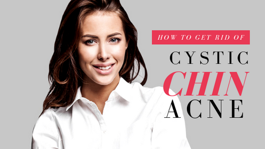 How To Get Rid of Cystic Acne On The Chin