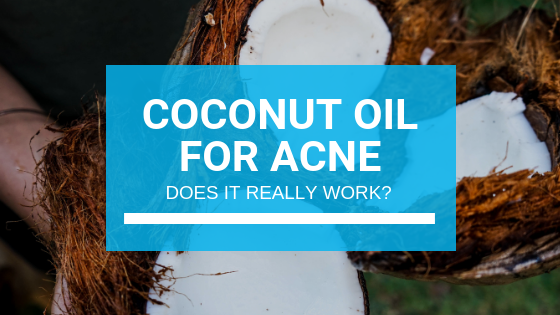 Coconut Oil for Acne: Does It Really Work?