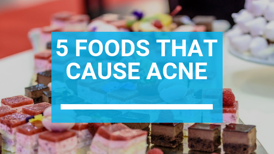 5 Foods That Cause Acne