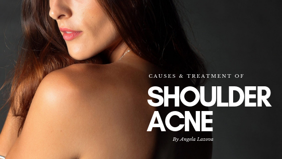 Causes of Shoulder Acne and What You Can Do About It