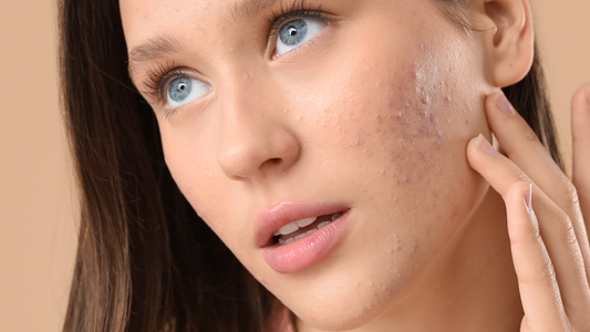 Average Acne Treatment Costs and Timelines