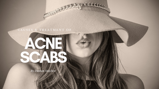 Acne Scabs: Causes and Treatment
