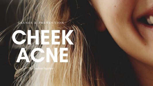 Cheek Acne: Causes And Prevention