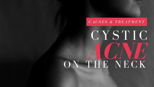 Cystic Acne On The Neck: Causes & Treatment