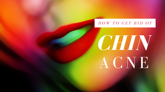 How To: Get Rid Of Chin Acne