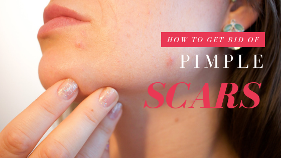 Pimple Scars: How To Get Rid Of Them