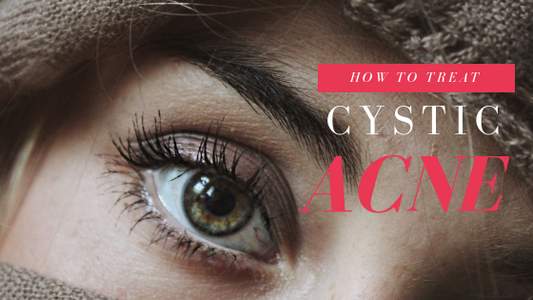 How To Treat Cystic Acne Effectively