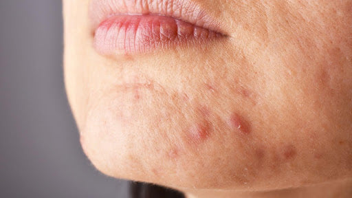 When a breakout isn't just a breakout: Skin problems that need a clinician
