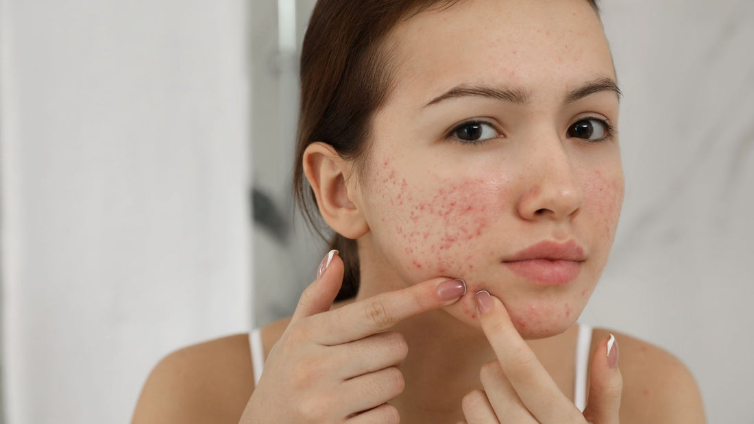 How Vitamin E Helps Fade Acne Scars Over Time