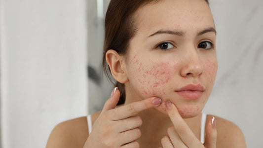 How Vitamin E Helps Fade Acne Scars Over Time