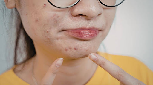 How Stress and Anxiety Trigger Skin Breakouts