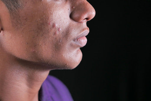 Does Stress Cause Acne and What Current Research Says