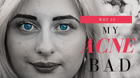 Why Is My Acne So Bad? (And What Can I Do About It?)